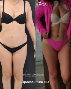 Resultados lipoescultura (1)