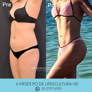 Resultados lipoescultura (1)