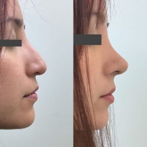 Rinoplastia resultados