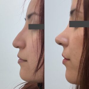 Rinoplastia resultados