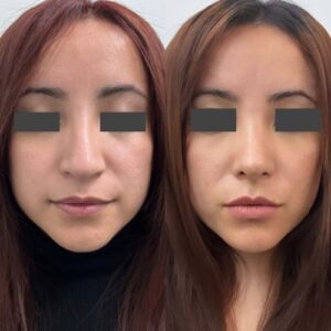 Rinoplastia resultados
