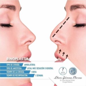Rinoplastia resultados