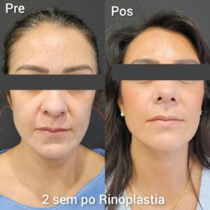 Rinoplastia resultados
