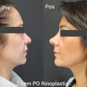 Rinoplastia resultados