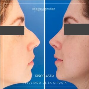 Rinoplastia resultados
