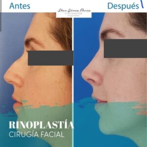 Rinoplastia resultados