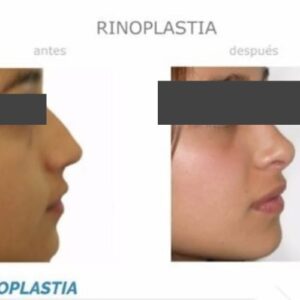 Rinoplastia resultados