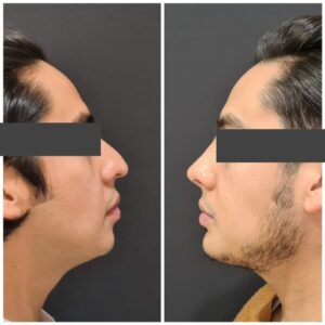 Rinoplastia resultados