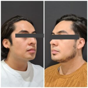Rinoplastia resultados