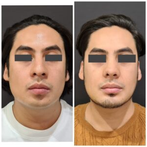 Rinoplastia resultados