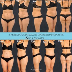 lipoabdominoplastia resultados