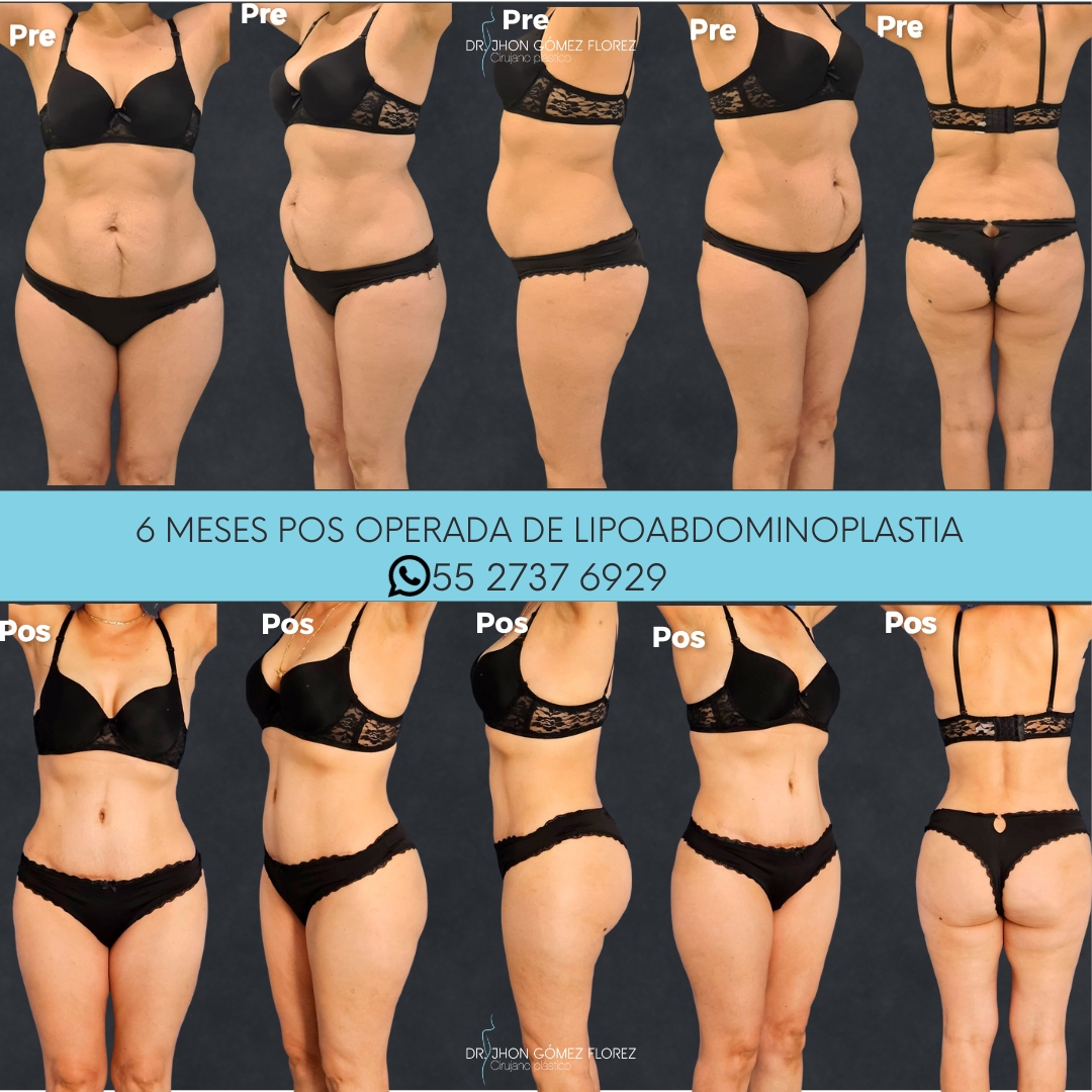 lipoabdominoplastia resultados