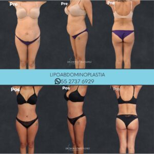 lipoabdominoplastia resultados