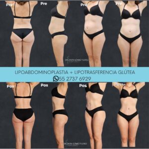 lipoabdominoplastia resultados