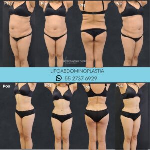 lipoabdominoplastia resultados