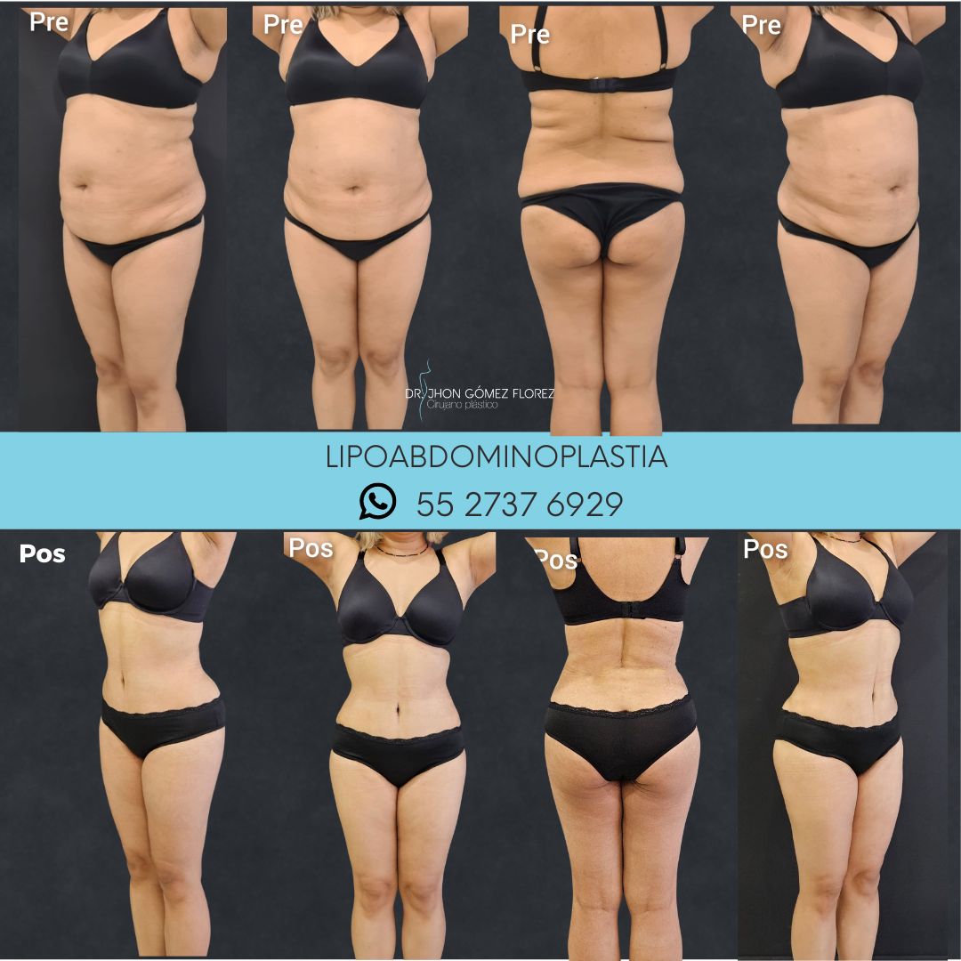 lipoabdominoplastia resultados