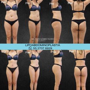 lipoabdominoplastia resultados