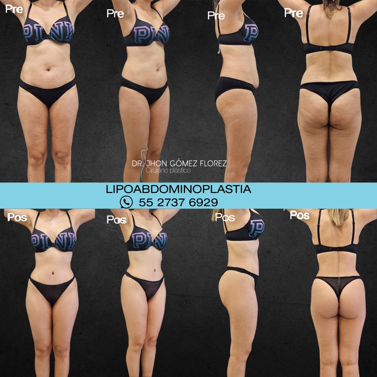 lipoabdominoplastia resultados