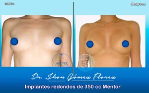 resultados mamoplastia