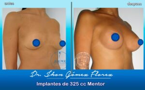 resultados mamoplastia