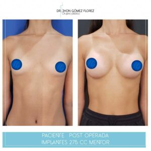 resultados mamoplastia
