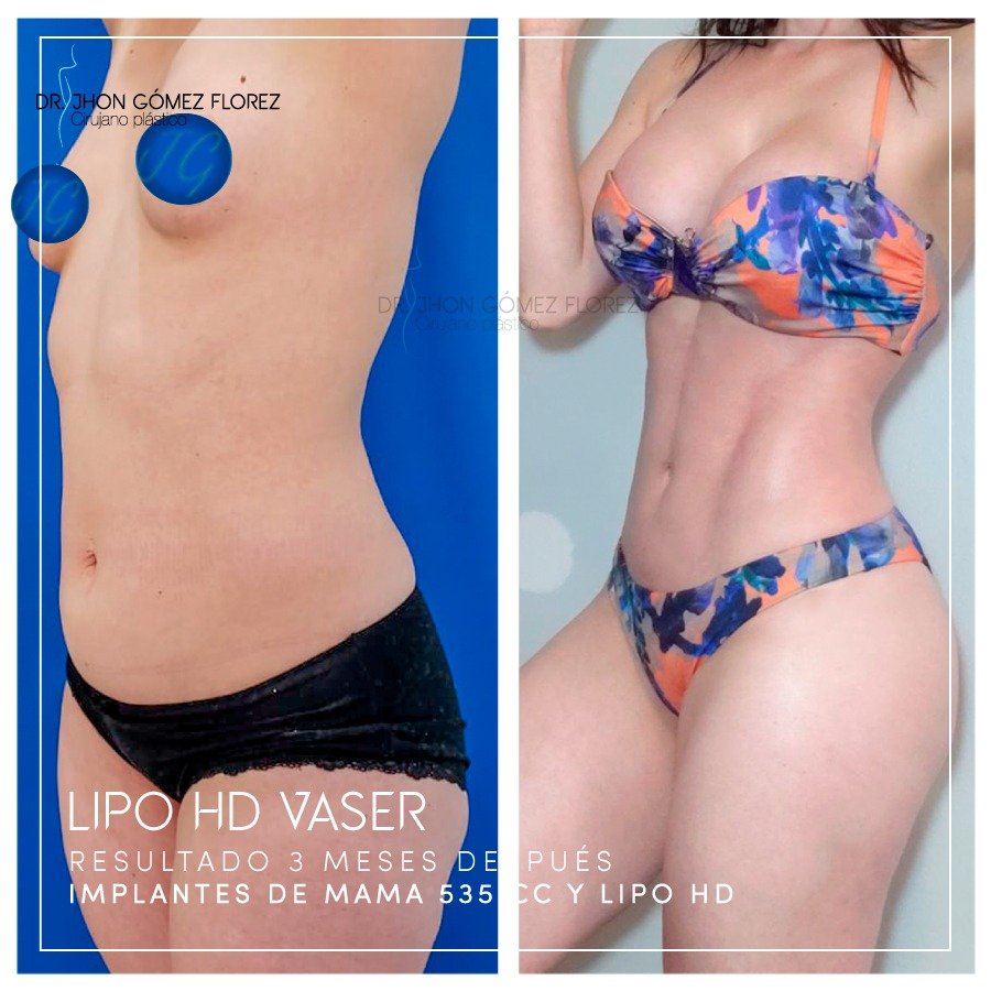 resultados mamoplastia