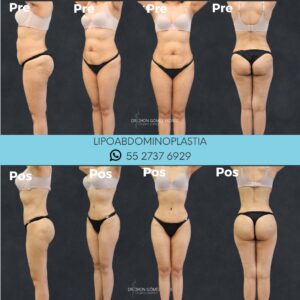 lipoabdominoplastia resultados