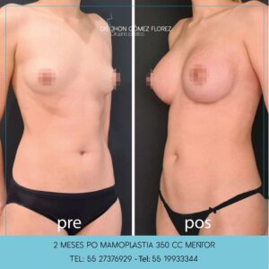 resultados aumento de mamas