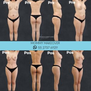 lipoabdominoplastia resultados