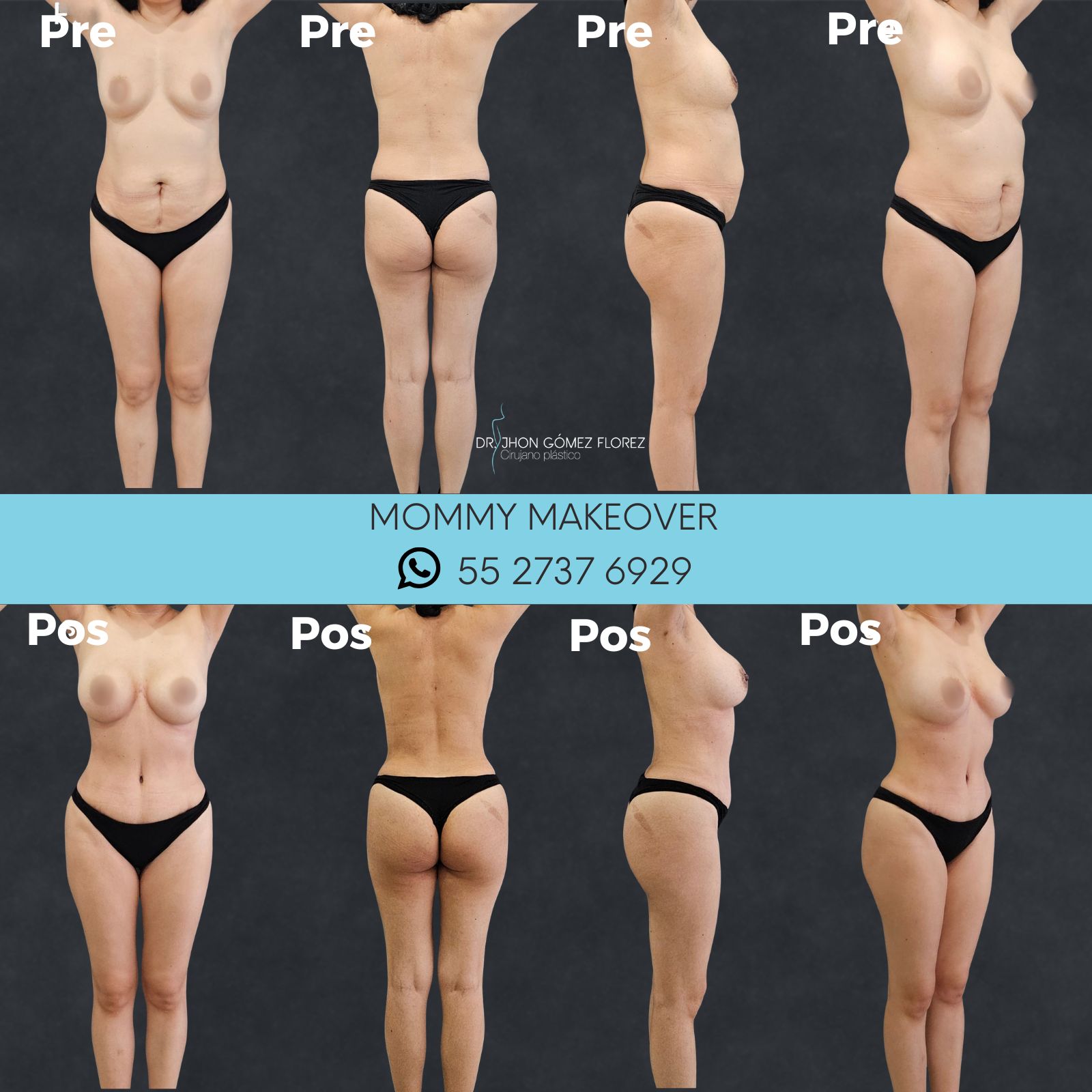 lipoabdominoplastia resultados