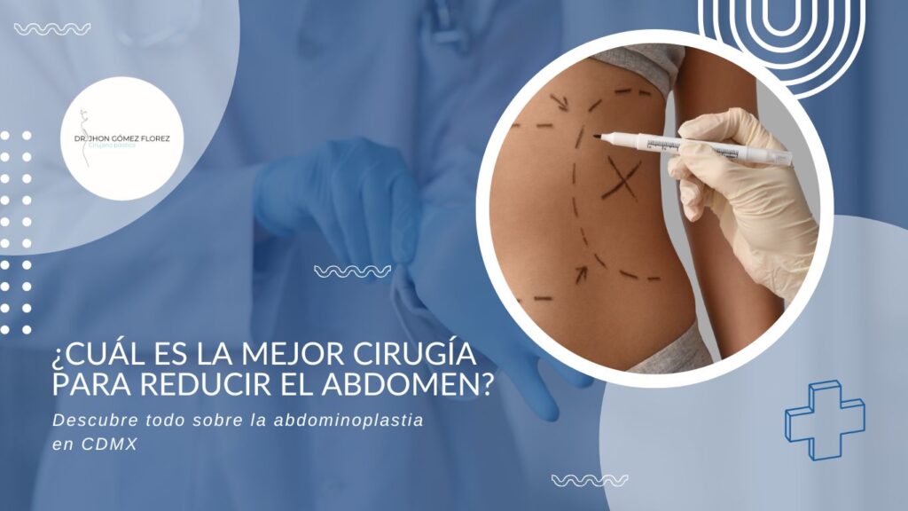 abdominoplastia en CDMX