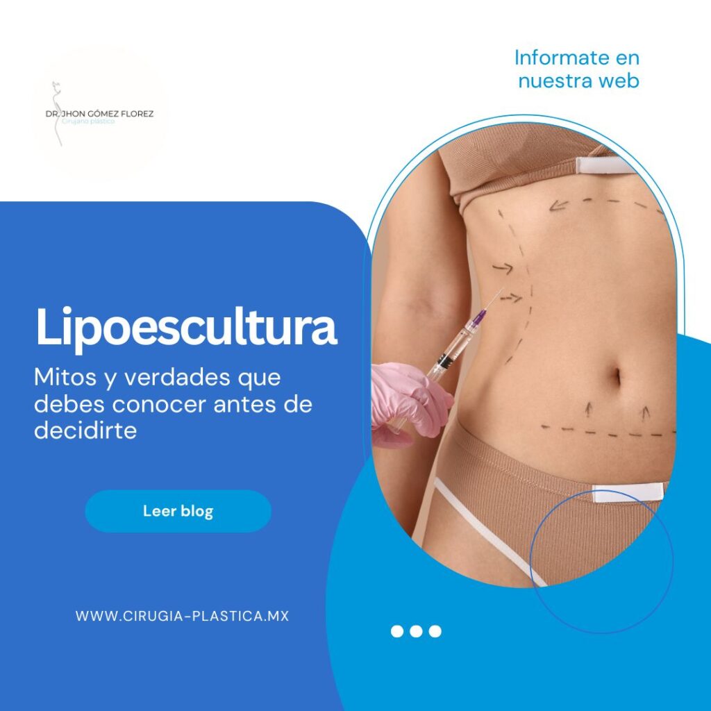 Lipoescultura: mitos y verdades