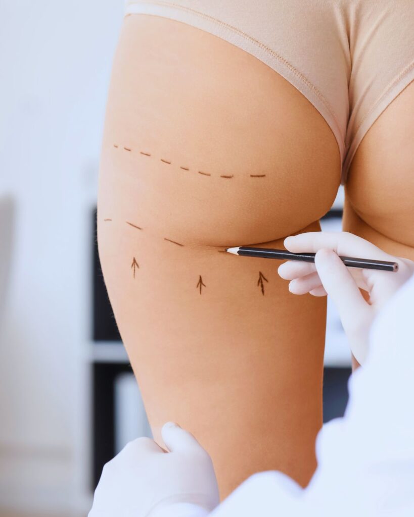 Lipotransferencia glútea