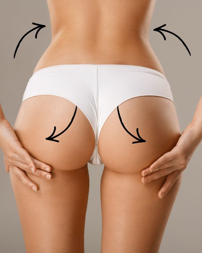 Lipotransferencia glútea