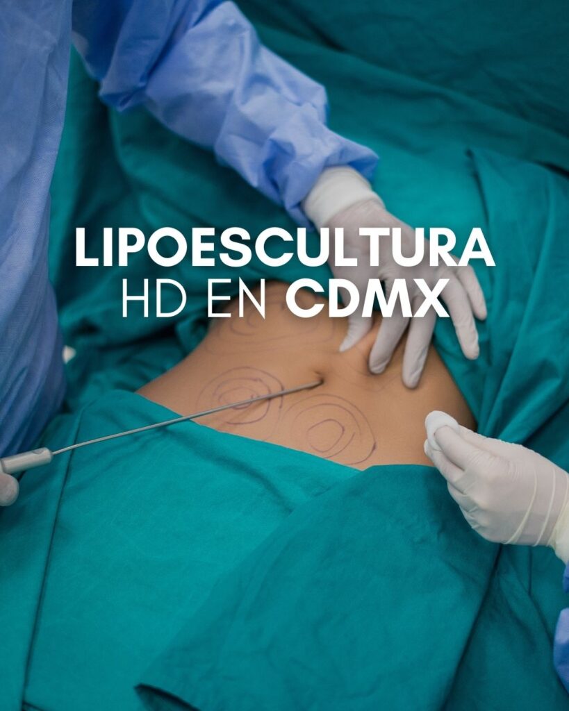 Lipoescultura HD en CDMX