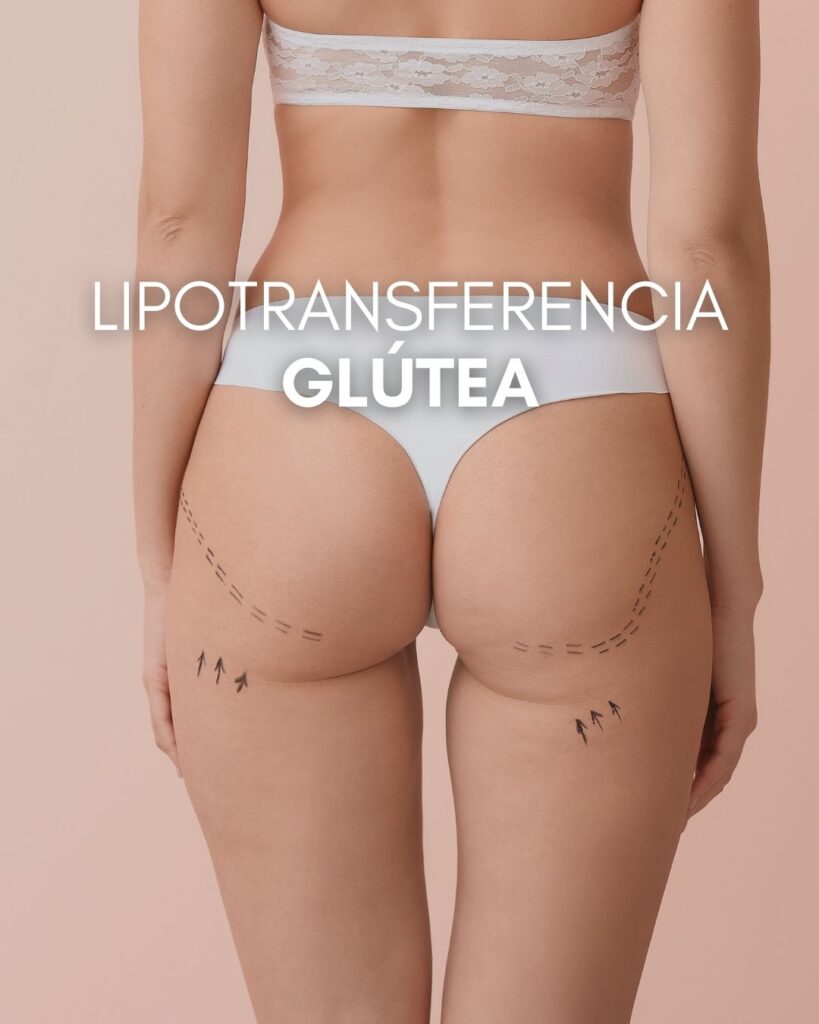 Lipotransferencia glútea