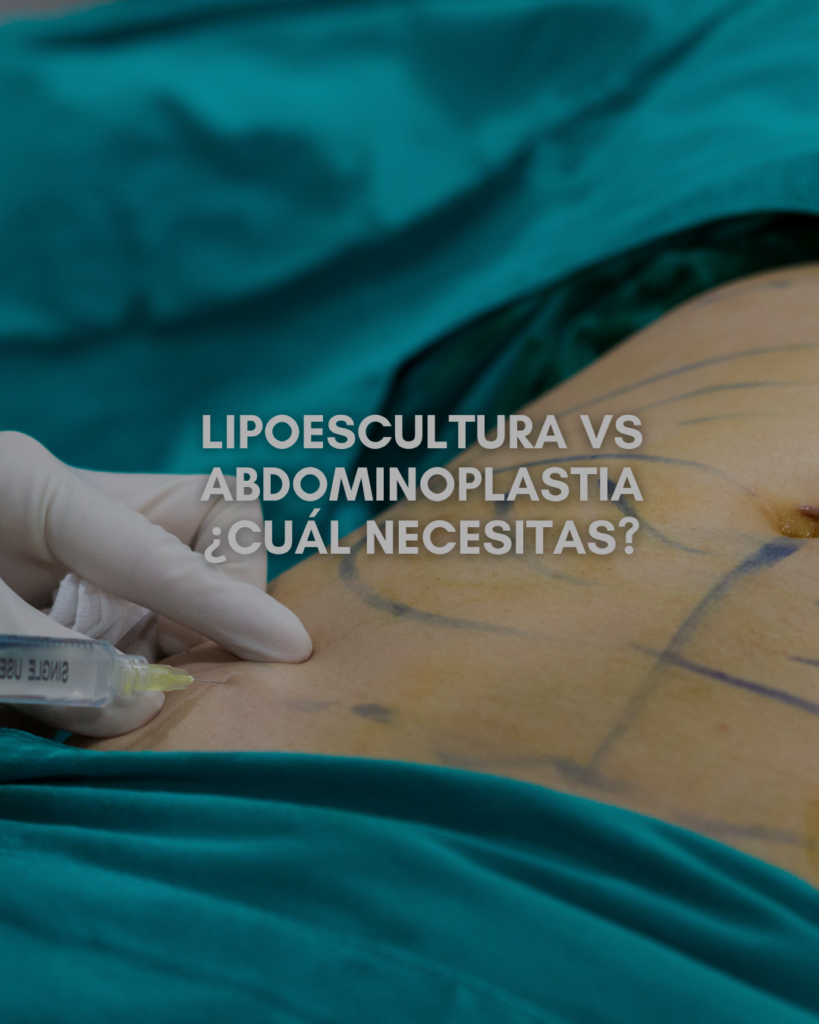 Lipoescultura vs Abdominoplastia