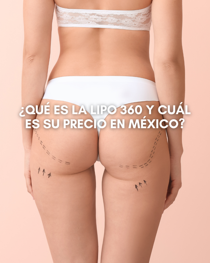 ¿Qué es la Lipo 360 y cuál es su precio en México?
