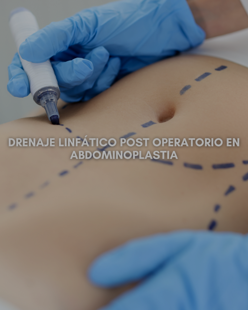 Drenaje Linfático Post Operatorio en Abdominoplastia