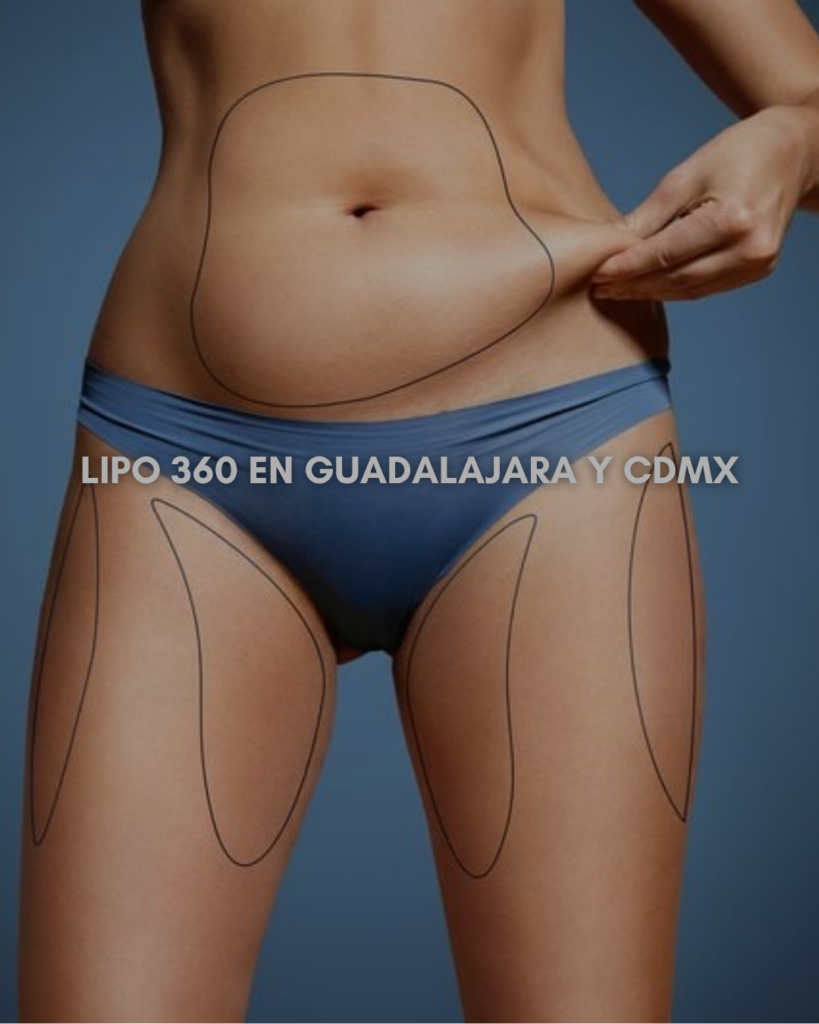 Lipo 360 en Guadalajara y CDMX Lipo 360 en Guadalajara y CDMX